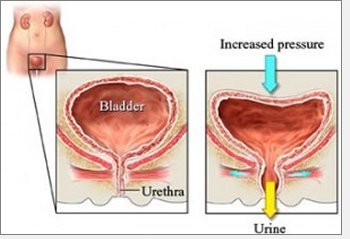 female incontinence